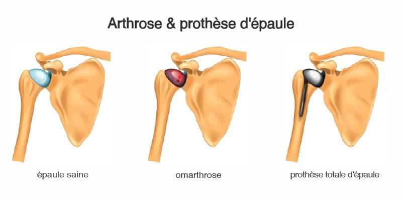 arthrose des epaules operation prothese d epaule anatomique ou inversee docteur charles schlur specialiste de la prothese d epaule a paris 16 et courbevoie