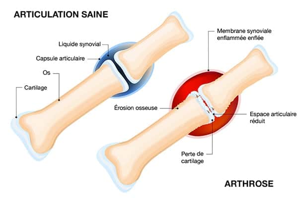 arthrose du poignet et gonflement symptomes chirurgien orthopediste epaule paris 16 dr charles schlur specialiste epaule a paris