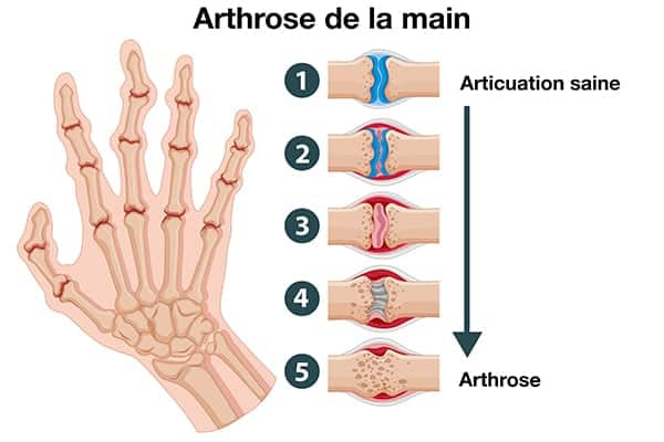 arthrose main poignet exercices chirurgien orthopediste epaule paris 16 dr charles schlur specialiste epaule a paris