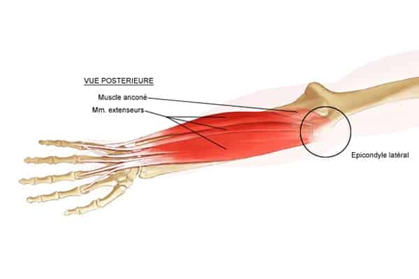 epicondylite du coude tratement tennis elbow exercises chirurgien orthopediste epaule paris 16 dr charles schlur specialiste epaule a paris