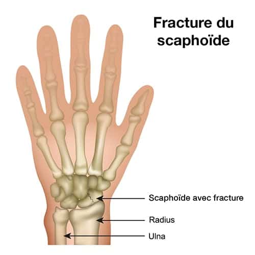 fracture du scaphoide les gestes a eviter chirurgien orthopediste epaule paris 16 dr charles schlur specialiste epaule a paris