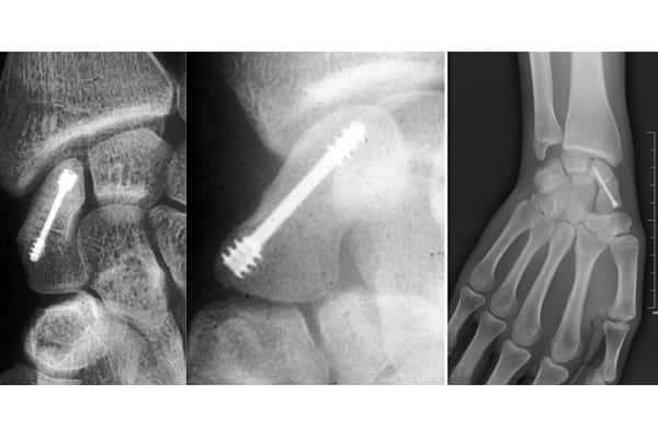 fracture os scaphoide main temps de guerison chirurgien orthopediste epaule paris 16 dr charles schlur specialiste epaule a paris