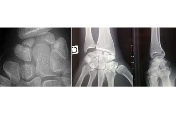 fracture scaphoide poignet reeducation chirurgien orthopediste epaule paris 16 dr charles schlur specialiste epaule a paris