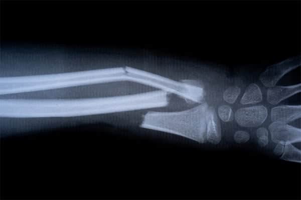 platre fracture poignet combien de temps chirurgien orthopediste epaule paris 16 dr charles schlur specialiste epaule a paris