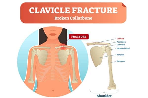 radio fracture clavicule deplacee convalescence chirurgien orthopediste epaule paris 16 dr charles schlur specialiste epaule a paris