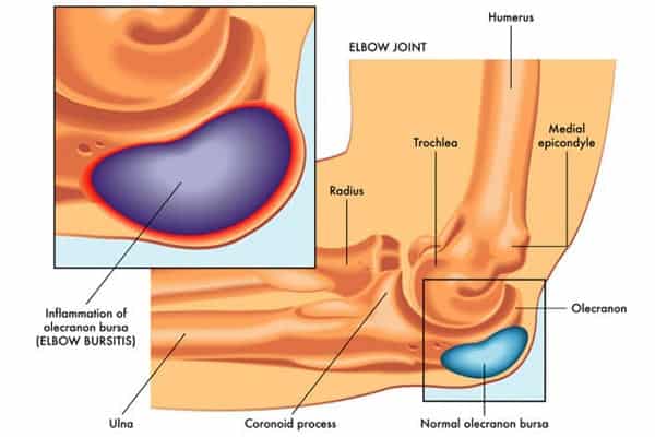 soigner un hygroma du coude traitement bursite coude image chirurgien orthopediste epaule paris 16 dr charles schlur specialiste epaule a paris