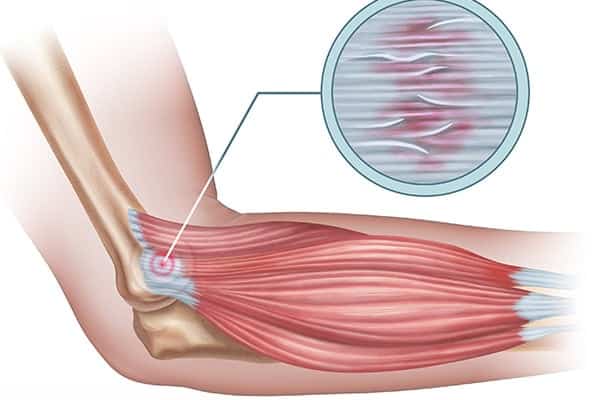 tennis elbow strapping traitement tendinite epicondylite chirurgien orthopediste epaule paris 16 dr charles schlur specialiste epaule a paris