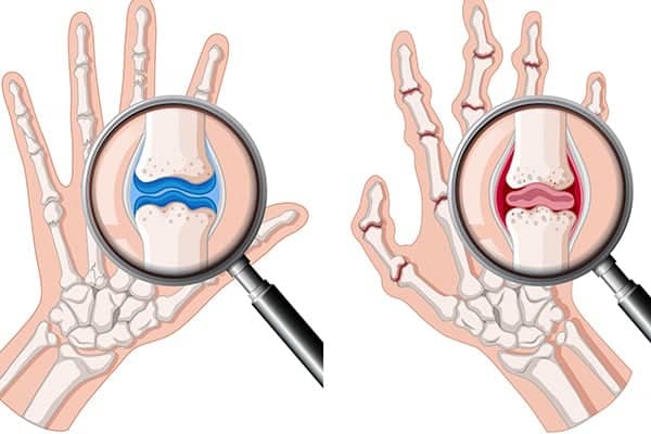 arthrose doigts et main execices chirurgien orthopediste epaule paris 16 dr charles schlur specialiste epaule a paris